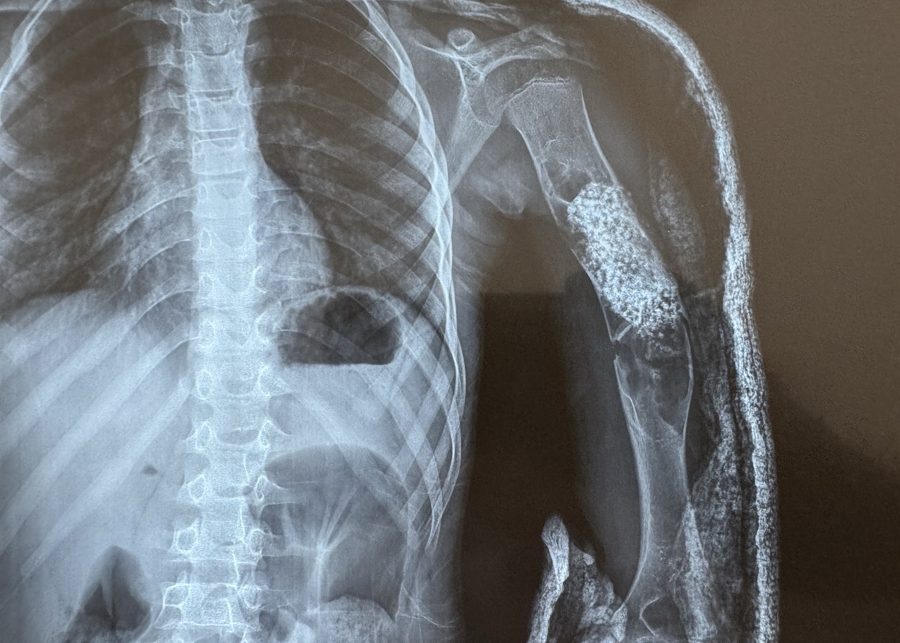 Case of the Week: Recurrent ABC