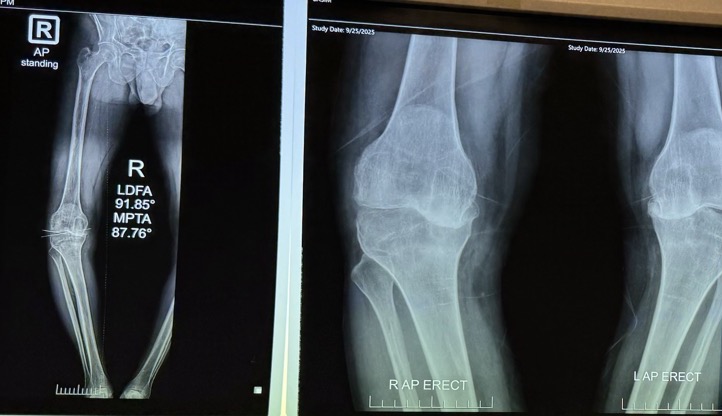 Case of the Week: Complex Knee OA with Varus Thrust and Multi-Ligamentous Instability